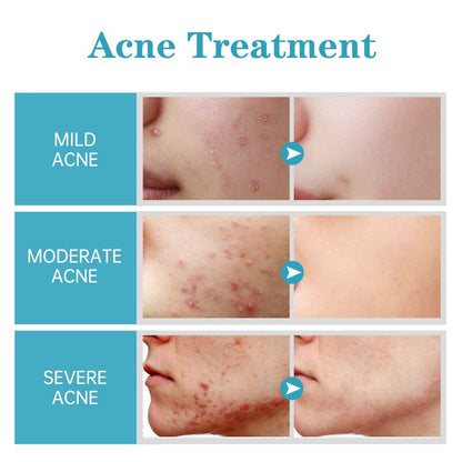 Women's Complete Acne Cream